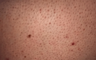 Keratoze na koži: kako ih prepoznati i kada potražiti pomoć dermatologa