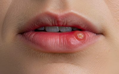 Što je herpes simplex virus (HSV)?