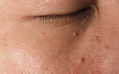 Prevencija – kako spriječiti pojavu i širenje bradavica