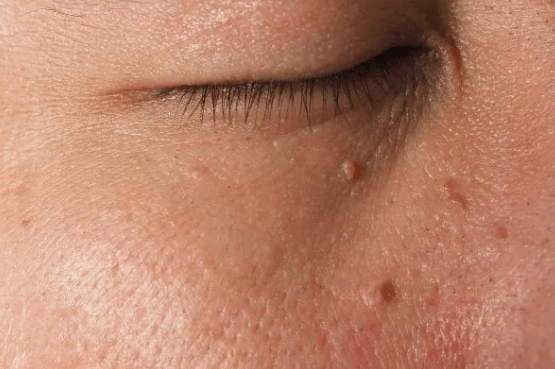 Kako ukloniti bradavice s lica (1)