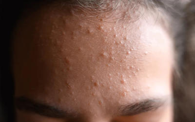 Kako svakodnevne navike utječu na pojavu komedona na licu